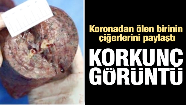 Koronadan ölen birinin ciğerlerini paylaştı
