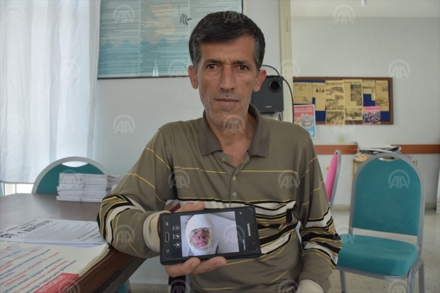 Yüzüne asit dökülen genç kız yardım bekliyor